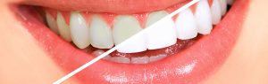 LASER BLEACHING